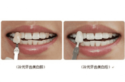 洗牙，牙齿美白的秘密武器