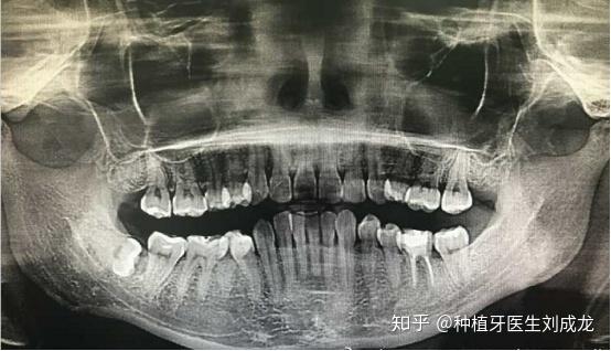 河南拔智齿,从网络热梗到全民热议的医学探索 河南拔智齿,从网络热梗到全民热议的医学探索