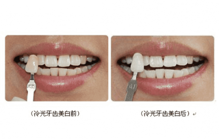 洗牙，牙齿美白的秘密武器