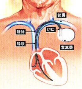原子能电池，未来能源的心脏起搏器